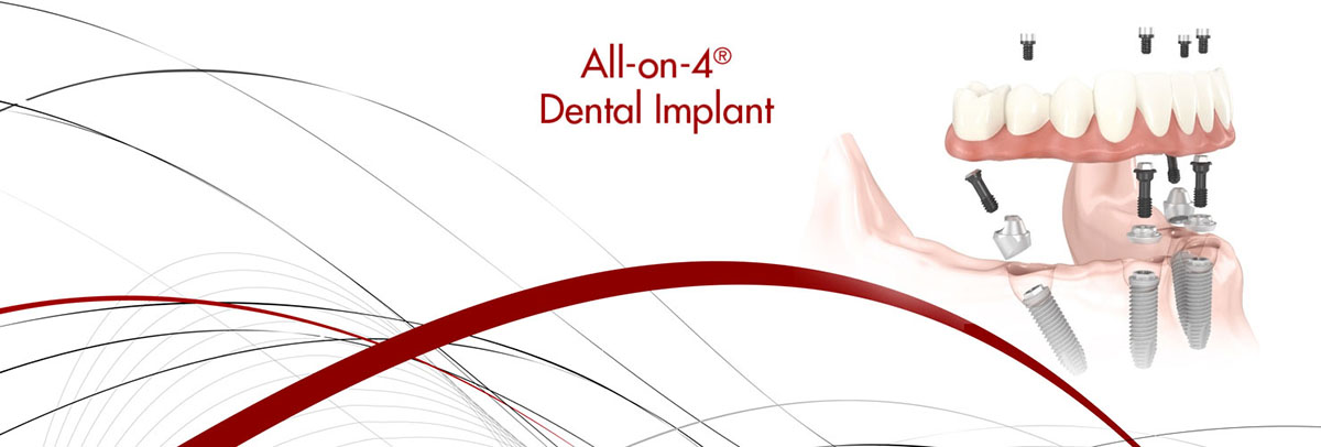 Armonk All-on-4 Dental Implants